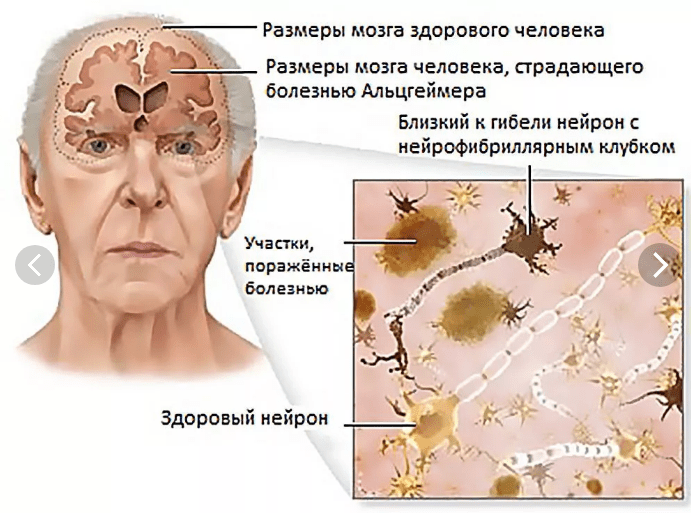 Разработан препарат против болезни Альцгеймера